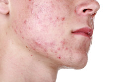 The Acne Files: Cause and Effects of Acne part 1