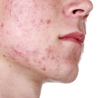 The Acne Files: Cause and Effects of Acne part 1