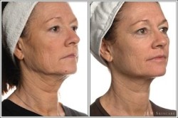 advanced-skin-therapy-of-smokey-point-microcurrent-facial